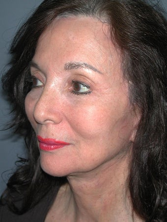 Chin Surgery on 65-year-old 841898