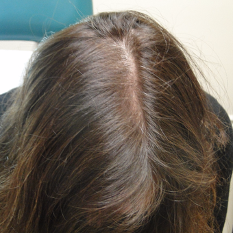 35-44 year old woman treated with PRP for Hair Loss after 2732183