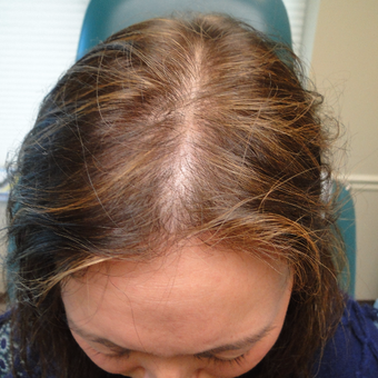 35-44 year old woman treated with PRP for Hair Loss before 2732183