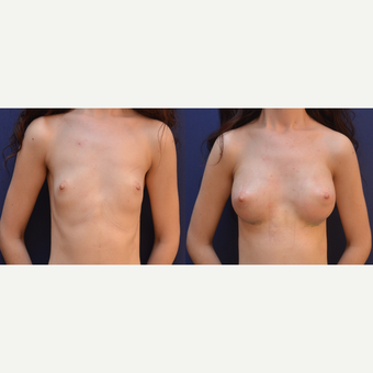 18-24 year old woman treated with Breast Augmentation before 3238838