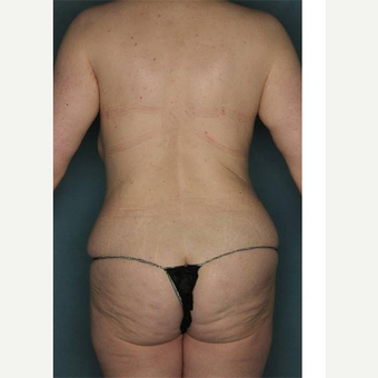 25-34 year old woman treated with Body Lift before 3421141