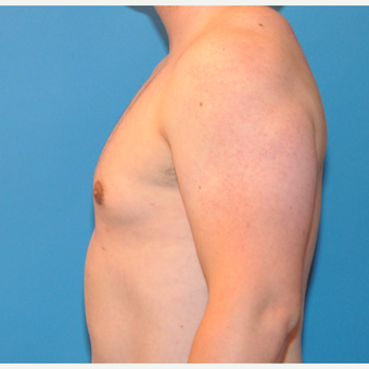 26 year old male treated with Male Breast Reduction after 3705450