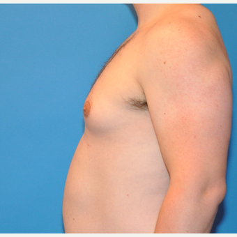 26 year old male treated with Male Breast Reduction before 3705450