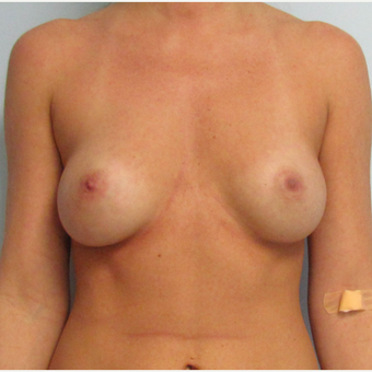 Breast Implant Revision - Larger Silicone Gel Breast Implants before 3030424