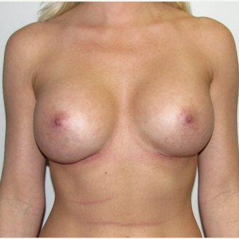 Breast Implant Revision - Larger Silicone Gel Breast Implants after 3030424