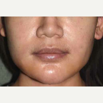 25-34 year old woman treated with Custom Jawline Implant after 3600649