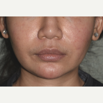25-34 year old woman treated with Custom Jawline Implant before 3600649