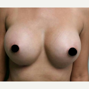 25-34 year old woman treated with Breast Augmentation after 3458547