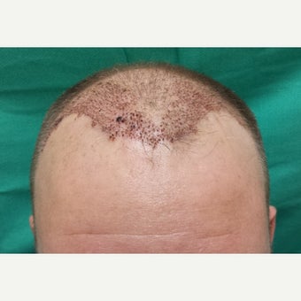 35-44 year old man treated with NeoGraft after 1717012