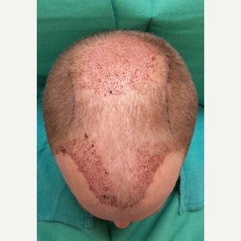 35-44 year old man treated with NeoGraft 1717012