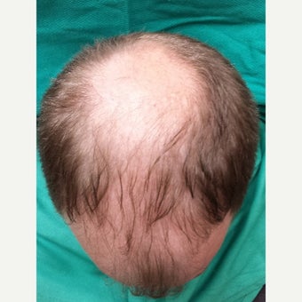 35-44 year old man treated with NeoGraft 1717012