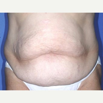 Mom feels so much better after Tummy Tuck and Liposuction of lower flanks. before 2246240