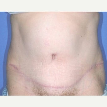 Mom feels so much better after Tummy Tuck and Liposuction of lower flanks. after 2246240