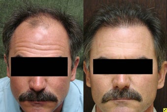 NeoGraft hair transplant before 545298