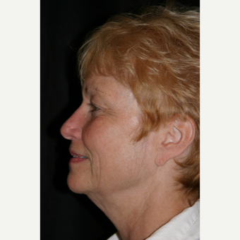 55-64 year old woman treated with Facelift before 3648637