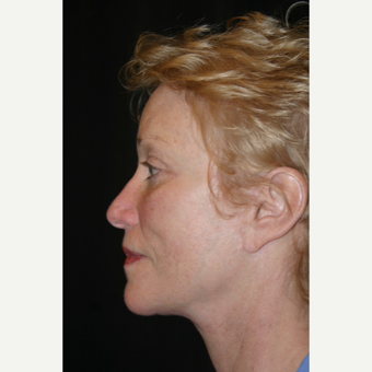 55-64 year old woman treated with Facelift after 3648637