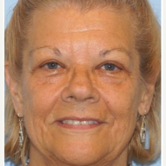 45-54 year old woman treated with Ptosis Surgery after 3727803
