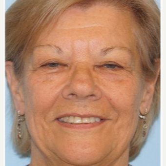 45-54 year old woman treated with Ptosis Surgery before 3727803