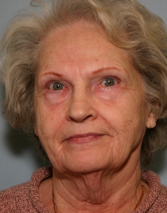 73 y/o Primary Facelift with Upper & Lower Blepharoplasty & Browlift 928161