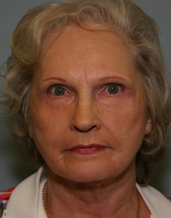 73 y/o Primary Facelift with Upper & Lower Blepharoplasty & Browlift 928161