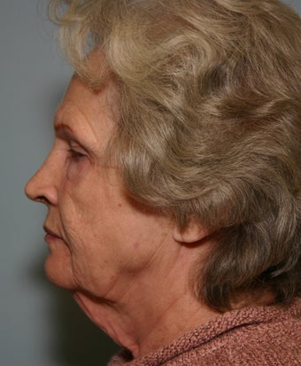 73 y/o Primary Facelift with Upper & Lower Blepharoplasty & Browlift before 928161