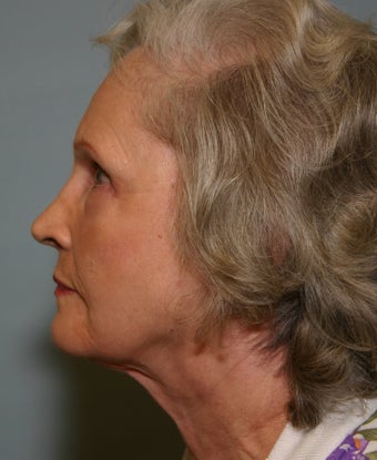 73 y/o Primary Facelift with Upper & Lower Blepharoplasty & Browlift after 928161