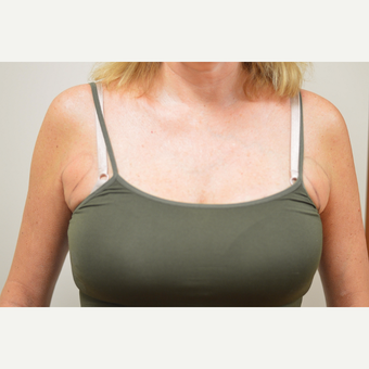 45-54 year old woman treated with CoolSculpting to Armpit Puffs before 3458516