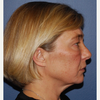 45-54 year old woman treated with MACS Facelift before 3428289
