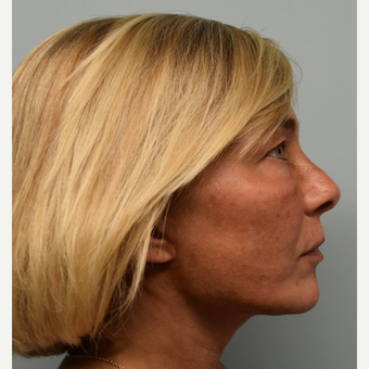 45-54 year old woman treated with MACS Facelift after 3428289