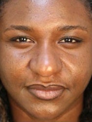 African American Female Rhinoplasty before 977644