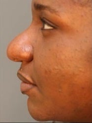 African American Female Rhinoplasty 977644