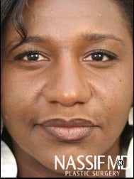 African American Female Rhinoplasty after 977644