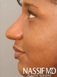 African American Female Rhinoplasty 977644