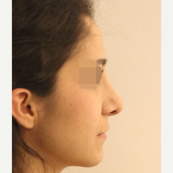 25-34 year old woman treated with Rhinoplasty after 3522500