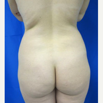 Liposuction before 3094210
