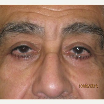 62 year old man treated with Eye Bags Treatment after 1896218