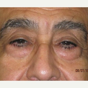 62 year old man treated with Eye Bags Treatment before 1896218
