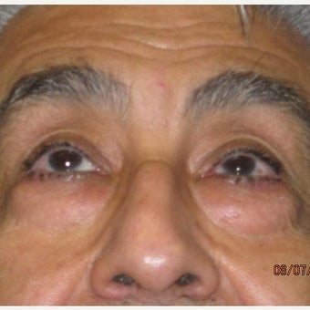 62 year old man treated with Eye Bags Treatment 1896218