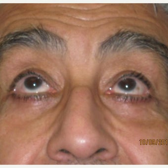62 year old man treated with Eye Bags Treatment 1896218