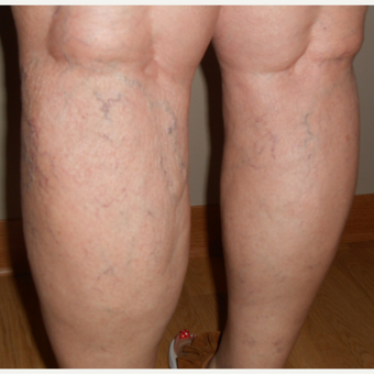 65-74 year old woman treated with Vein Treatment before 3161473