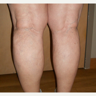65-74 year old woman treated with Vein Treatment after 3161473