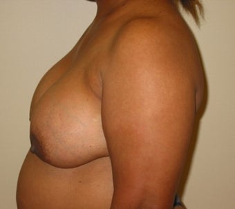 Implant removal on 47 year old patient 1884243