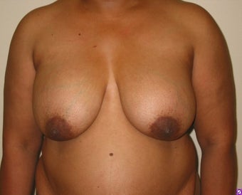 Implant removal on 47 year old patient before 1884243