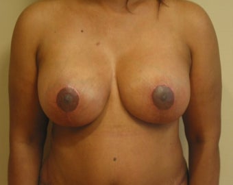 Implant removal on 47 year old patient after 1884243