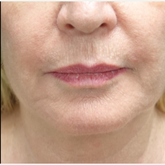 55-64 year old woman treated with Fat Transfer for her Lip Augmentation before 3130007