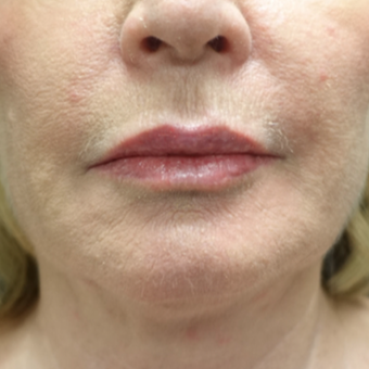 55-64 year old woman treated with Fat Transfer for her Lip Augmentation after 3130007