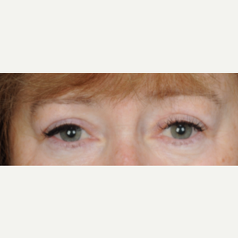 60 year old woman treated with Eyelid Surgery (upper blepharoplasty) after 3839729