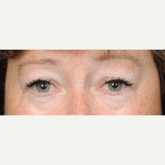 60 year old woman treated with Eyelid Surgery (upper blepharoplasty) before 3839729