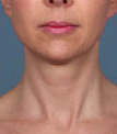 Woman treated with Kybella after 2061774