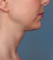 Woman treated with Kybella 2061774